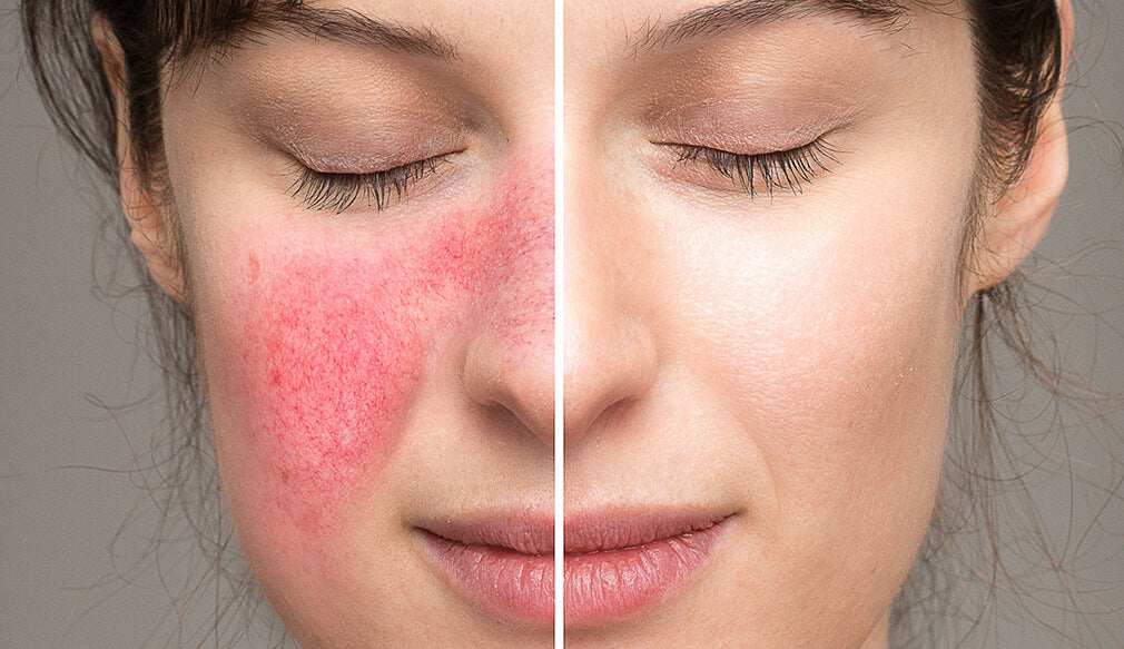 Say Goodbye to Dermatitis: Topical Probiotics Offer a Natural Solution